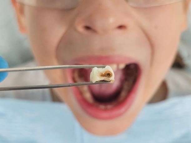 Best Emergency Treatment for Dental Infections or Abscesses in Beulah, ND